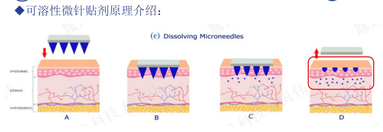可溶性微针贴剂
